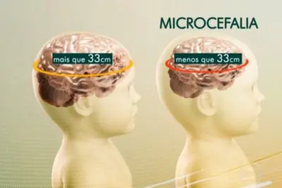Saúde confirma 1.113 casos de microcefalia no país