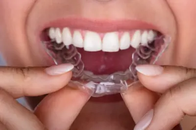 Invisalign: o tratamento ortodôntico transparente que está conquistando as jovens