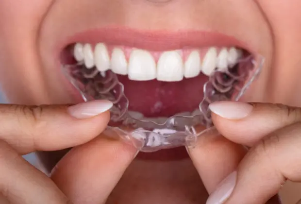 Invisalign: o tratamento ortodôntico transparente que está conquistando as jovens