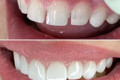 Dicas sobre as famosas lentes dentais pelo especialista e dentista Bryan Arlean