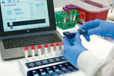 Teste rápido para detecção da tuberculose latente recebe aprovação da Anvisa e estará disponível em breve no Brasil