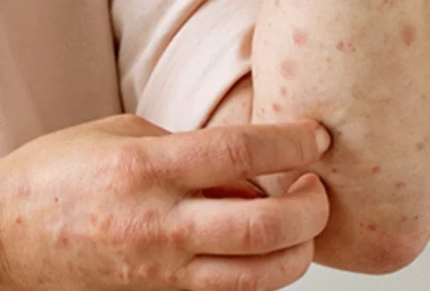 Região de Campinas registra cinco casos de mpox, confirma Secretaria Estadual de Saúde