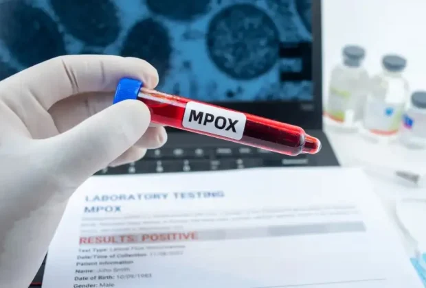 Região de Campinas registra casos de mpox em 2026 sem óbitos e com pacientes recuperados